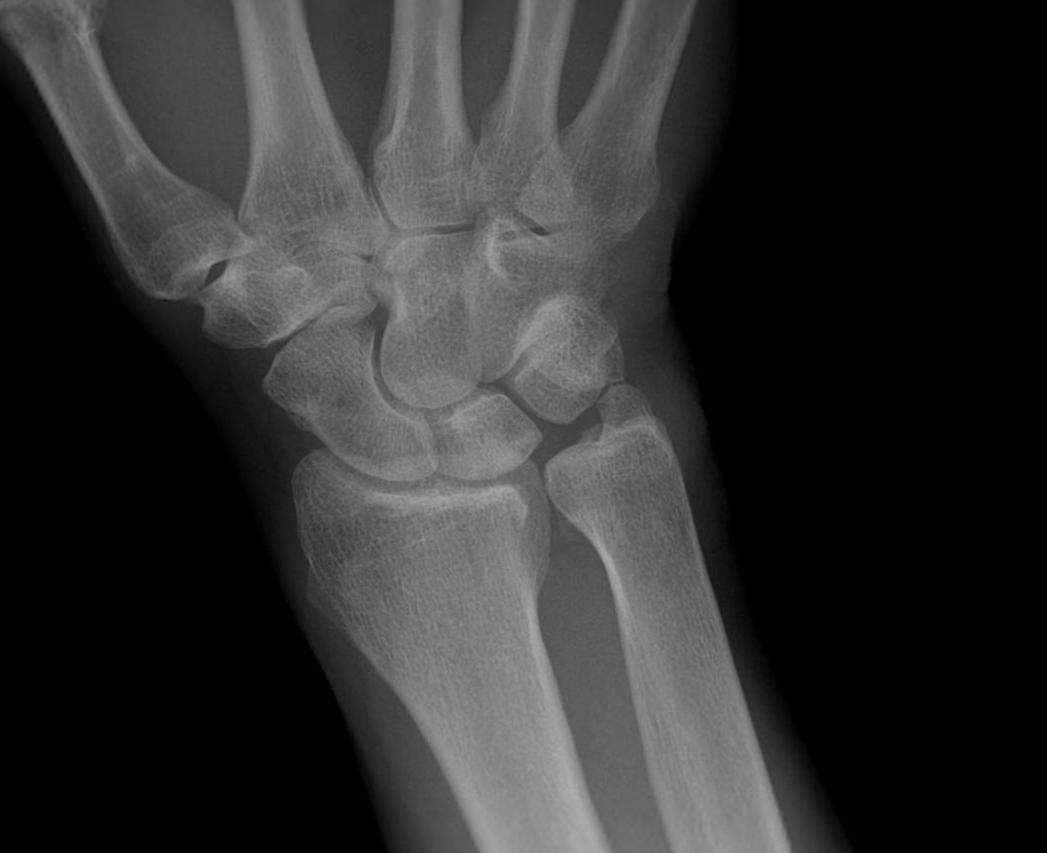 Ulna Positive with abutment